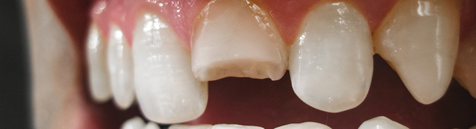🥇 Atlanta GA Chipped Tooth Repair